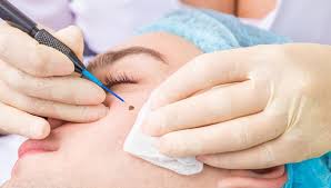 Đốt nốt ruồi nhiều lần, người đàn ông bất ngờ nhận tin dữ